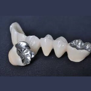 Porcelana fundida en metal