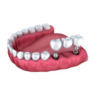 Implantes